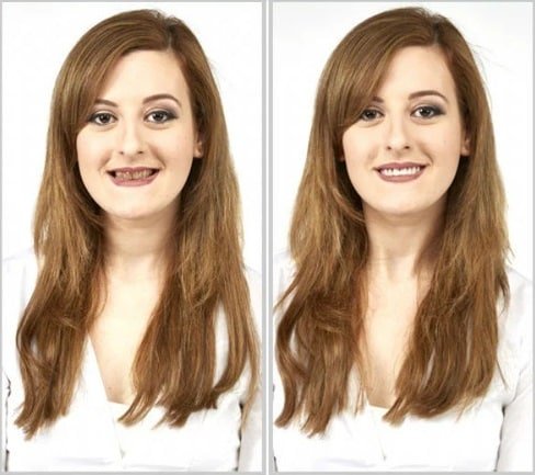 kozmetikai műfogsor – felpattintható fogsor takaró kozmetikai műfogsor – felpattintható fogsor takaró